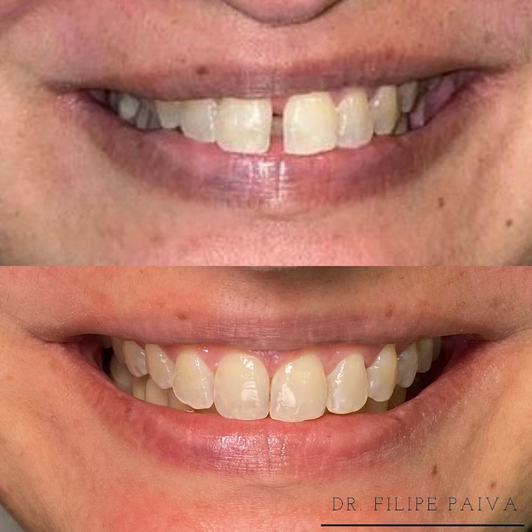 Comparação do sorriso antes do tratamento, na parte superior, e depois do tratamento, na parte inferior